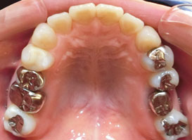 【症例9】反対咬合(受け口) 抜歯② 上顎 9年後