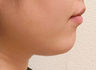 【症例9】上顎前突（出っ歯）①after