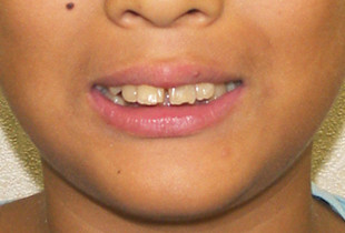 【症例4】小児非抜歯出っ歯 正面 before