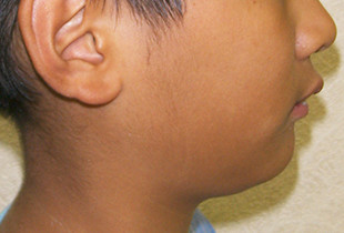 【症例4】小児非抜歯出っ歯 横顔・左 before