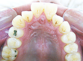 【症例6】上顎前突（出っ歯） 上顎 before