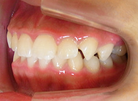【症例18】異所萌出（上顎第二小臼歯が口蓋側に転位、捻転した叢生症例） 右 before