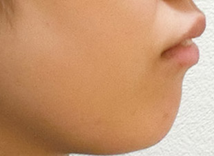 【症例9】上顎前突（出っ歯）①before