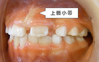 【症例2】正中離開(前歯がすきっ歯)2