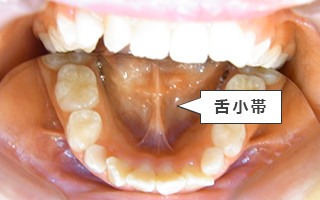 【症例2】正中離開(前歯がすきっ歯)3