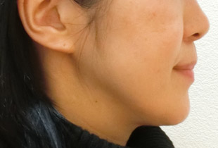 【症例9】反対咬合(受け口) 抜歯② 右 9年後