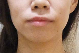 【症例15】反対咬合(受け口) 非抜歯 右 before