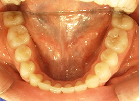 【症例10】空隙歯列(すきっ歯) 下顎 after