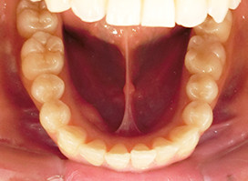 【症例13】インプラントと矯正の併用① 下顎 after