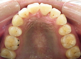 【症例6】上顎前突（出っ歯） 上顎 after