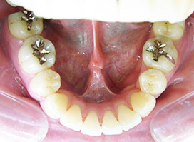 【症例6】上顎前突（出っ歯） 下顎 after