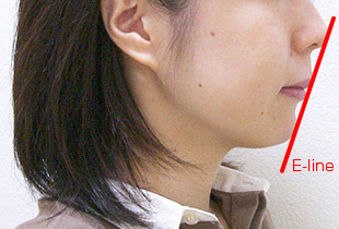 口元集 右 after