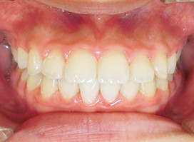 【症例18】異所萌出（上顎第二小臼歯が口蓋側に転位、捻転した叢生症例） 正面 after