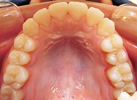 【症例18】異所萌出（上顎第二小臼歯が口蓋側に転位、捻転した叢生症例） 上顎 after