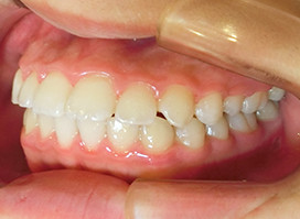 【症例18】異所萌出（上顎第二小臼歯が口蓋側に転位、捻転した叢生症例） 右 after