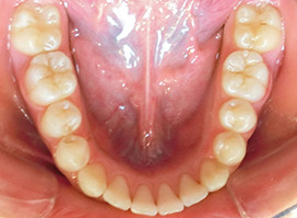 【症例18】異所萌出（上顎第二小臼歯が口蓋側に転位、捻転した叢生症例） 下顎 after
