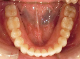 【症例8】上顎前突（出っ歯）過蓋咬合（深い咬み合わせ） 下顎 after