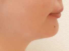 【症例8】上顎前突（出っ歯）過蓋咬合（深い咬み合わせ） 右 after