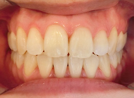 【症例26】開咬　叢生　空隙　(他院からの再治療) 正面 after