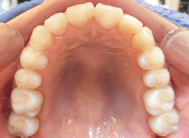 【症例26】開咬　叢生　空隙　(他院からの再治療) 上顎 after
