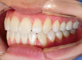 【症例26】開咬　叢生　空隙　(他院からの再治療) 右 after