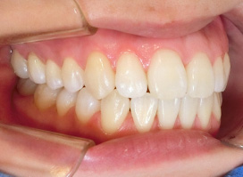 【症例26】開咬　叢生　空隙　(他院からの再治療) 左 after