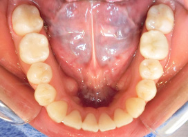 【症例26】開咬　叢生　空隙　(他院からの再治療) 下顎 after