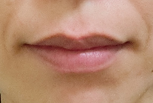 【症例26】開咬　叢生　空隙　(他院からの再治療) 正面 after