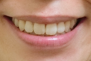 【症例26】開咬　叢生　空隙　(他院からの再治療) 正面 after