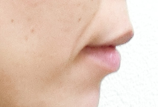 【症例26】開咬　叢生　空隙　(他院からの再治療) 右 after