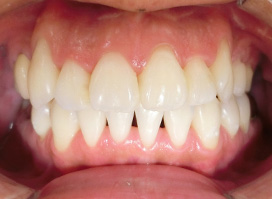 【症例10】上顎前突（出っ歯）　開咬　叢生 正面 after