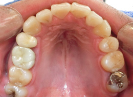 【症例10】上顎前突（出っ歯）　開咬　叢生 上顎 after