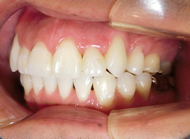 【症例10】上顎前突（出っ歯）　開咬　叢生 右 after