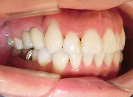 【症例10】上顎前突（出っ歯）　開咬　叢生 左 after