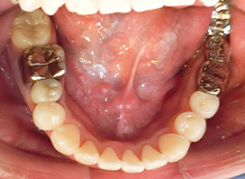 【症例10】上顎前突（出っ歯）　開咬　叢生 下顎 after