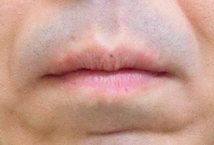 【症例10】上顎前突（出っ歯）　開咬　叢生 正面 after