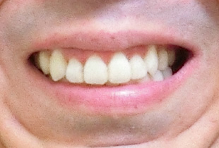 【症例10】上顎前突（出っ歯）　開咬　叢生 正面 after