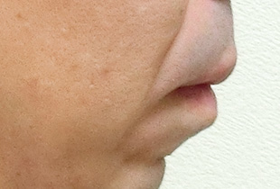 【症例10】上顎前突（出っ歯）　開咬　叢生 右 after