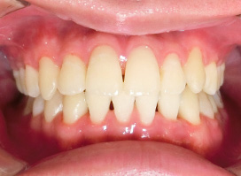 【症例25】インプラントと矯正の併用③（反対咬合(受け口)　叢生　左下第二小臼歯先天欠如） 正面 after