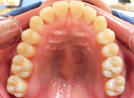 【症例25】インプラントと矯正の併用③（反対咬合(受け口)　叢生　左下第二小臼歯先天欠如） 上顎 after