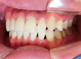 【症例25】インプラントと矯正の併用③（反対咬合(受け口)　叢生　左下第二小臼歯先天欠如） 右 after