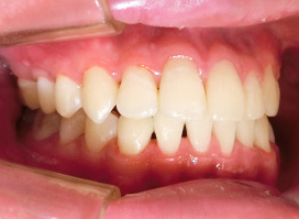 【症例25】インプラントと矯正の併用③（反対咬合(受け口)　叢生　左下第二小臼歯先天欠如） 左 after