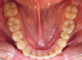 【症例25】インプラントと矯正の併用③（反対咬合(受け口)　叢生　左下第二小臼歯先天欠如） 下顎 after