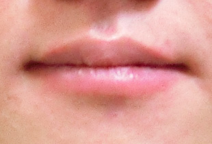 【症例25】インプラントと矯正の併用③（反対咬合(受け口)　叢生　左下第二小臼歯先天欠如） 正面 after