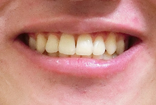 【症例25】インプラントと矯正の併用③（反対咬合(受け口)　叢生　左下第二小臼歯先天欠如） 正面 after