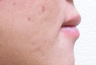 【症例25】インプラントと矯正の併用③（反対咬合(受け口)　叢生　左下第二小臼歯先天欠如） 右 after