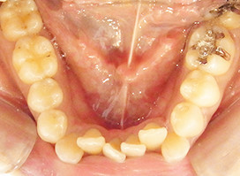 【症例1】叢生非抜歯① 下顎 before