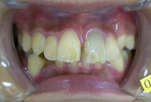 【症例4】小児非抜歯出っ歯 正面・左 before