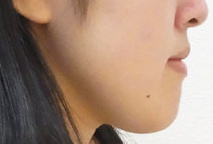 【症例8】反対咬合(受け口) 抜歯① 右 before