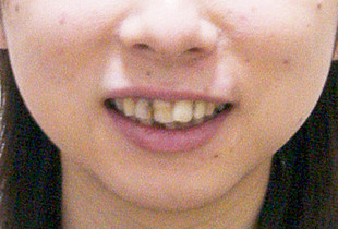 【症例19】結婚式に合わせた治療 正面 before